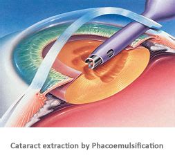 Cataract Surgery Phoenix